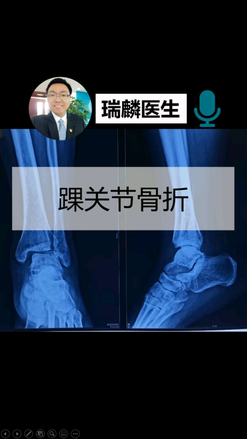 景博JBO体育平台-穆西亚拉腓骨骨折+韧带受伤预计伤缺4-5个月的简单介绍